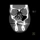 Sequestrum, osteomyelitis of upper jaw, maxilla: CT - Computed tomography